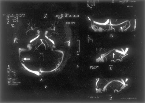 Figure From Cerebral Mr Venography Of Transverse Sinuses In Subjects