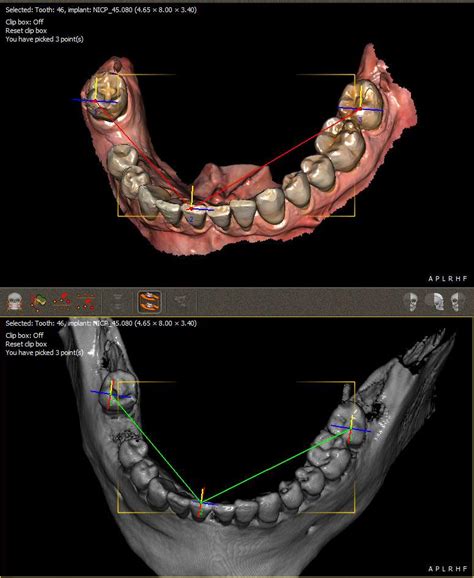 Cone Beam Le Gold Standard De La Chirurgie Dentaire