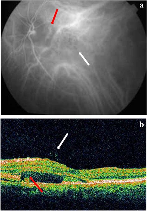 A Indocyanine Green Angiography Icga Of A Patient With Punctate Outer