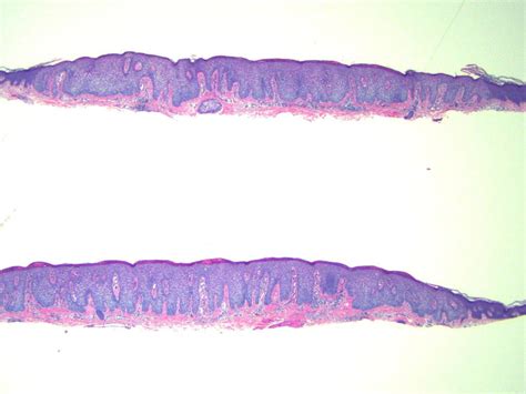 Clear Cell Acanthoma -2x | DermPath Daily