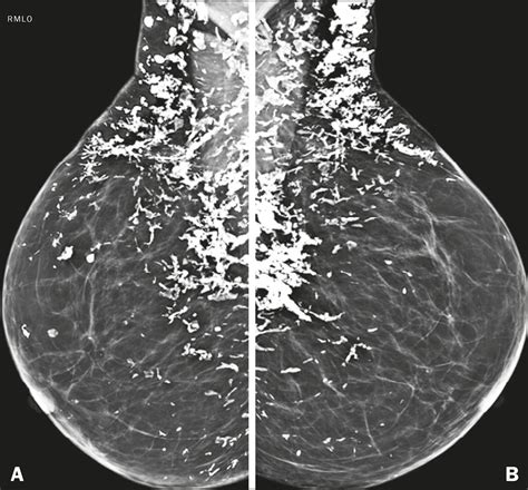 Scielo Brasil Radiological Findings Of Breast Involvement In Benign