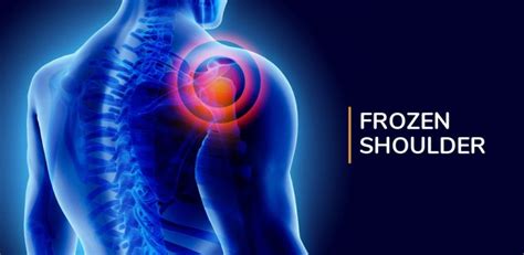 Frozen Shoulder Treatment Best Frozen Shoulder Physiotherapy Center