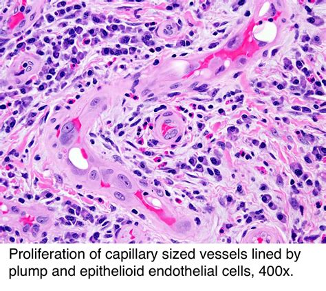 Pathology Outlines Epithelioid Hemangioma