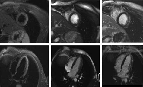 3 Cmr Tissue Characterization In Myocarditis Images Obtained In A