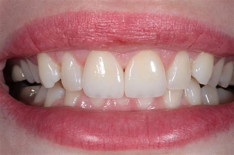 Dental Aesthetics - Kutay Ortodonti