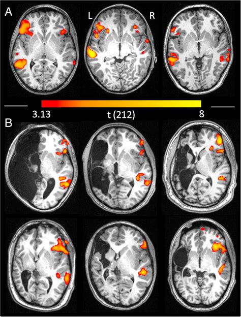 Wernickes Aphasia Mri