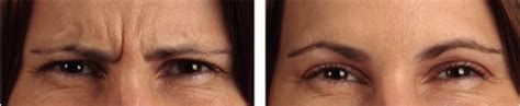 Forehead Frown Glabella Line Anti Wrinkle Treatment