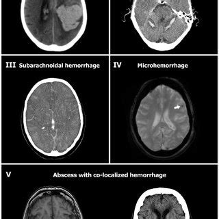 Types Of Intracranial Hemorrhagic Complications Encountered In