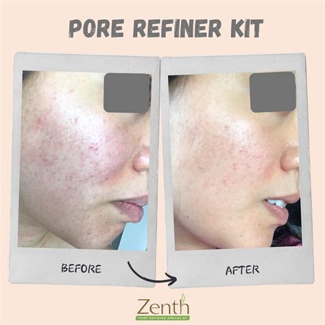 Zenth Pore Refining Specialist