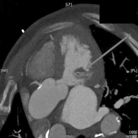 A B Preoperative Computed Tomography Angiography Findings Arrow Download Scientific