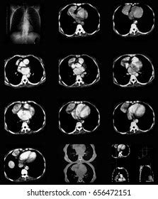 Computed Tomography Ct Scan Chest Abdomen Stock Photo