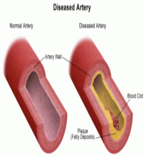 Arterial Venous Disorders Flashcards Quizlet