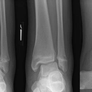 Case Anteroposterior Mortise And Lateral Radiographic Views Of The