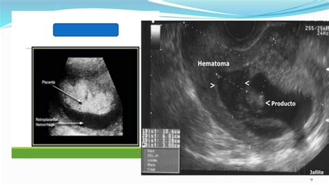 Hemorragia Placentaria Ppt