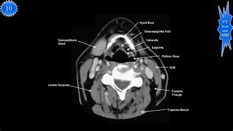 What Does A Soft Tissue Neck Ct Scan Show Ct Scan Machine Images