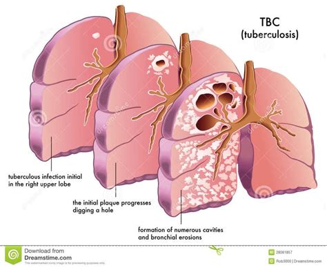 Tuberculosis Tb Tuberculosis Medical Illustration Medical Mnemonics