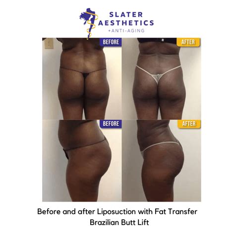 Brazilian Butt Lift Sculptra Butt Lift Results Dr Monte Slater