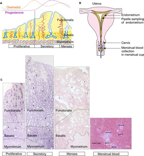 Endometrial stromal sarkom: Endometrial stromal sarcoma – PMC