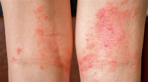 How To Get Rid Of Contact Dermatitis Distancetraffic19