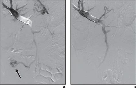 Figure 164 From Reduction In Portal Venous Pressure By Transjugular