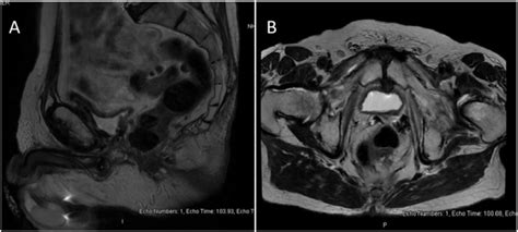 Pelvic Magnetic Resonance Imaging A Sagittal B Axial T2 Weightted Download Scientific