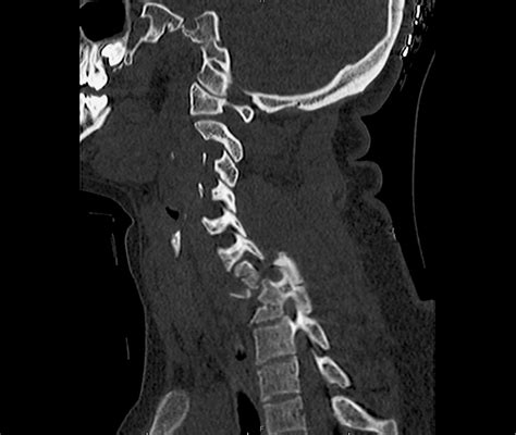 Spine Tags - Differential Diagnosis of