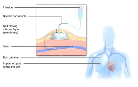 Illustration port catheter - MedicalGraphics