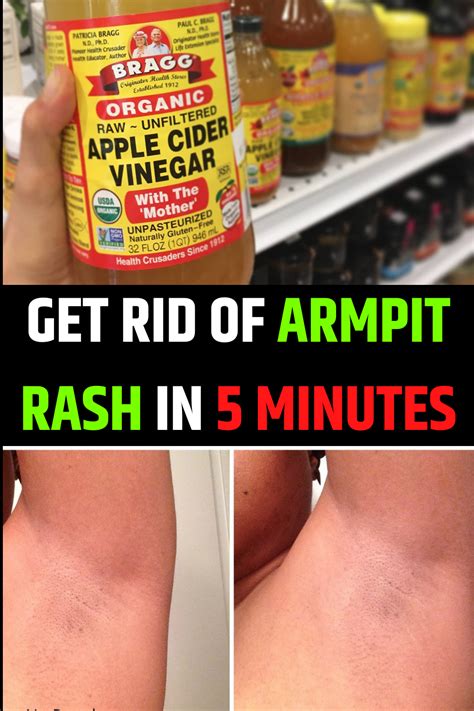 How To Get Rid Of Armpit Rash Armpit Rash The Cure Rashes