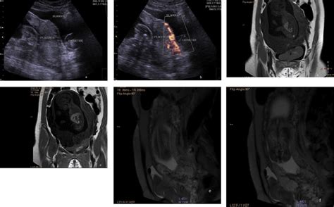 Placenta Percreta Transabdominal Us A And Power Doppler B Shows Download Scientific Diagram