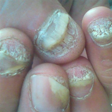 Best Nail Fungal Inhibitor & Repairing Agent for Damaged Nails