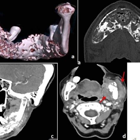 Dentigerous Cyst With Ectopic Tooth 26 Year Old Male A Vrt Image Download Scientific Diagram