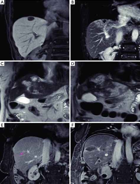 Representative Cases Of Various Lrt Modalities A Pre Procedure T