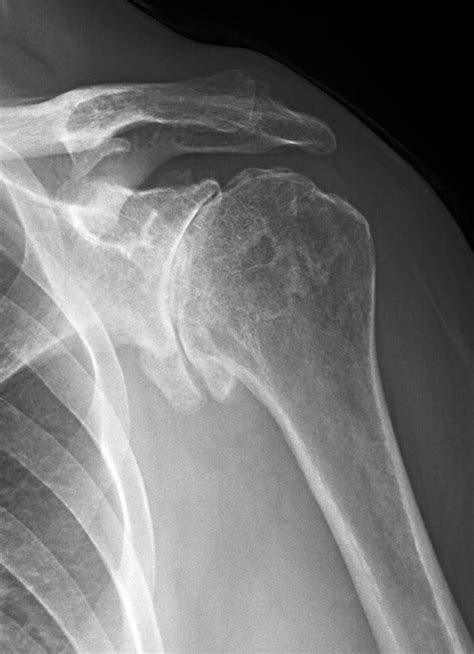 Shoulder Arthritis – Dr. Edward Weldon