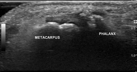 Radial Collateral Ligament Thumb Pain