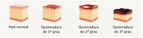 Graus De Queimadura E Extensão Corporal Instituto Brasileiro De