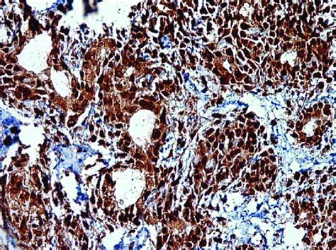 High Power Photomicrograph Exhibits A Strong Nuclear Cytoplasmic BRCA1