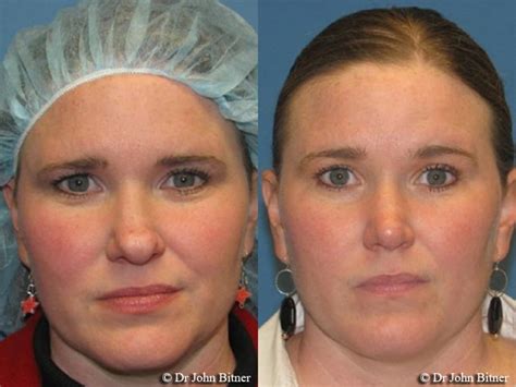 Rhinoplasty Layton Ut Bitner Plastic Surgery