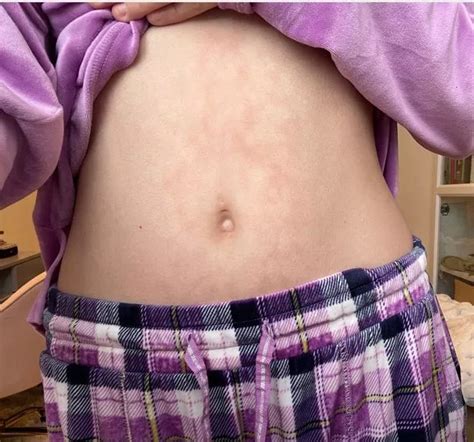 Woman Left With Horrific Burn From Hot Water Bottle After Refusing To Pay For Heating The