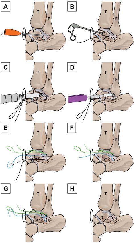 Nonanatomic All Inside Arthroscopic Anterior Talofibular 45 Off