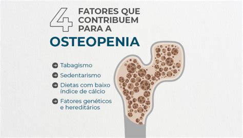 4 Fatores Que Contribuem Para A Osteopenia Grupo De Ombro Da Santa Casa