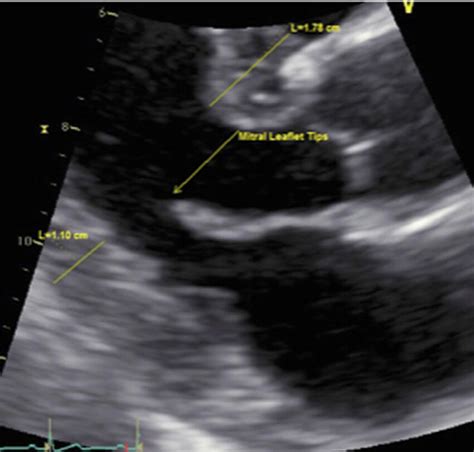 The Parasternal Long Axis Plax View Showing The Asymmetrical