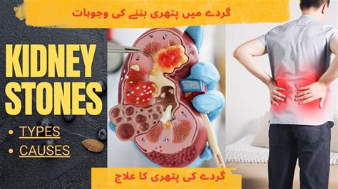 Gurde Ka Drd Kidney Stone Gurde Ki Pathri Ka Ilaj What Causes Kidney