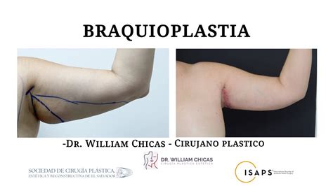 Braquioplastia Cirugia Para Brazos Gruesos Dr William Chicas