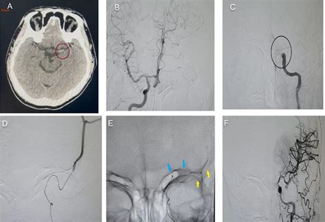 Figure 1 From Double Stent Retriever Technique For Rescue