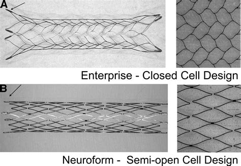 Advances In Interventional Neuroradiology Stroke