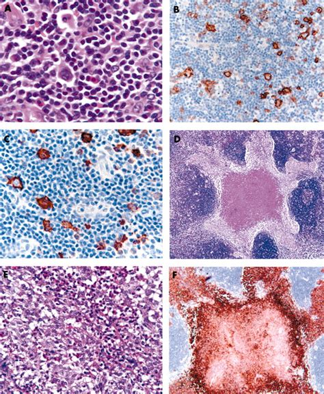 Langerhans Cell Histiocytosis In Sequential Discordant Lymphoma