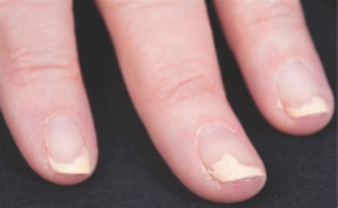 Nail Disease Onychomadesis Nail Disorders Strong Nails Fingernails