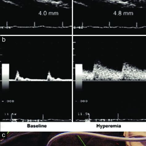 Assessment Of Endothelial Function In Vivo Using Blood Pressure Cuff