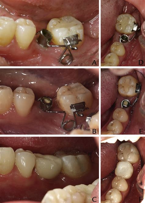 Uprighting A Mesially Tilted Mandibular Left Second Molar With