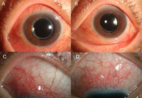 Toxocariasis Causes Symptoms Diagnosis Treatment And Prognosis